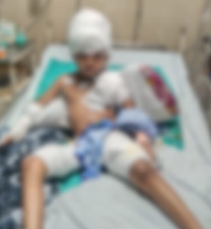 दलदल सिवनी दया नगर में आवारा कुत्तों का आतंक, 5 वर्षीय बच्चा बना शिकार